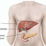 Gallbladder Cancer