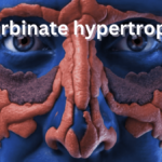 Turbinate hypertrophy