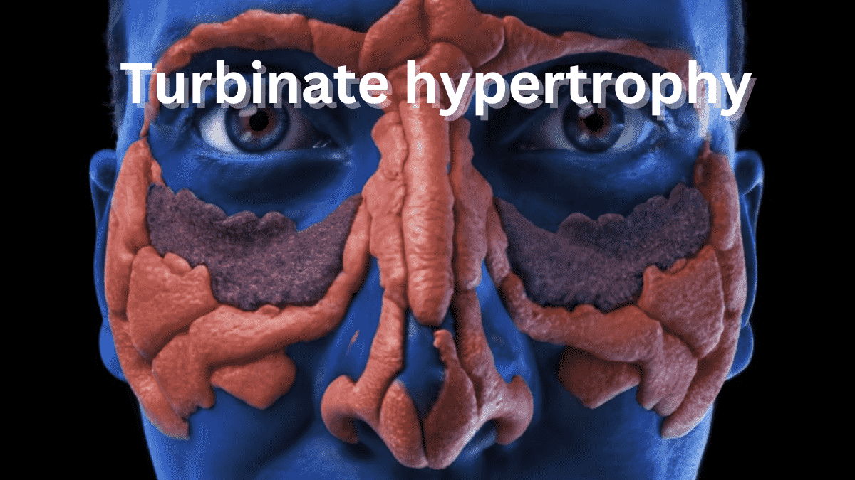 Turbinate hypertrophy