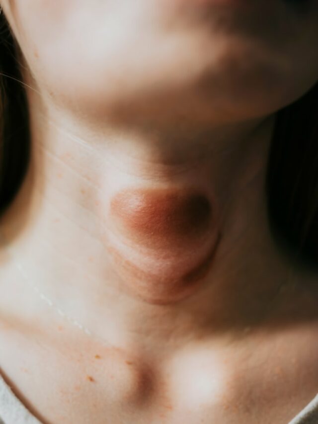 Never ignore these 9 Symptoms of Hyperthyroidism